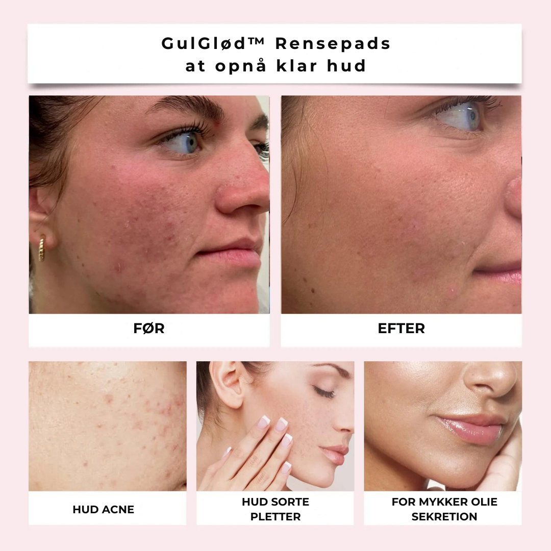 Revolutionerende Rensepads | Skin-Boost Formel Pakke med 30 | Vanero