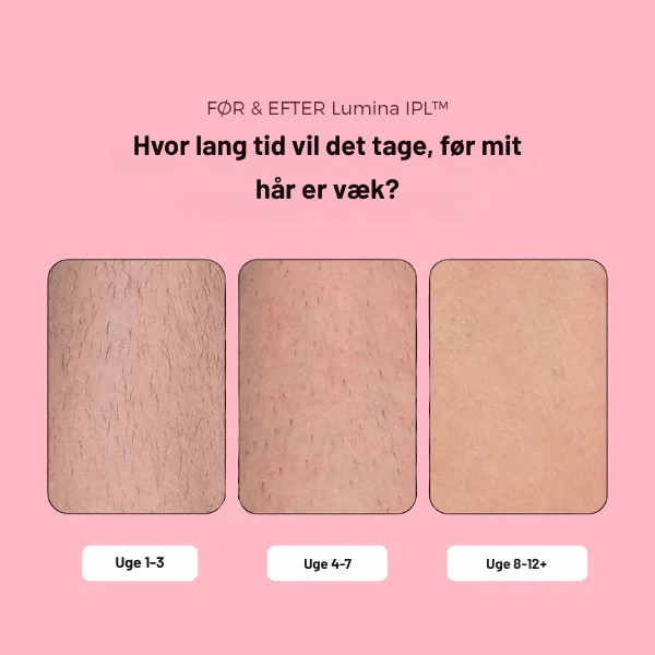 Lumina IPL | Avanceret IPL Til Hjemmebrug | Vanero